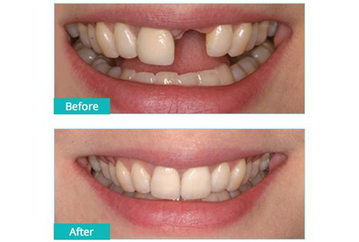 Dental Implant