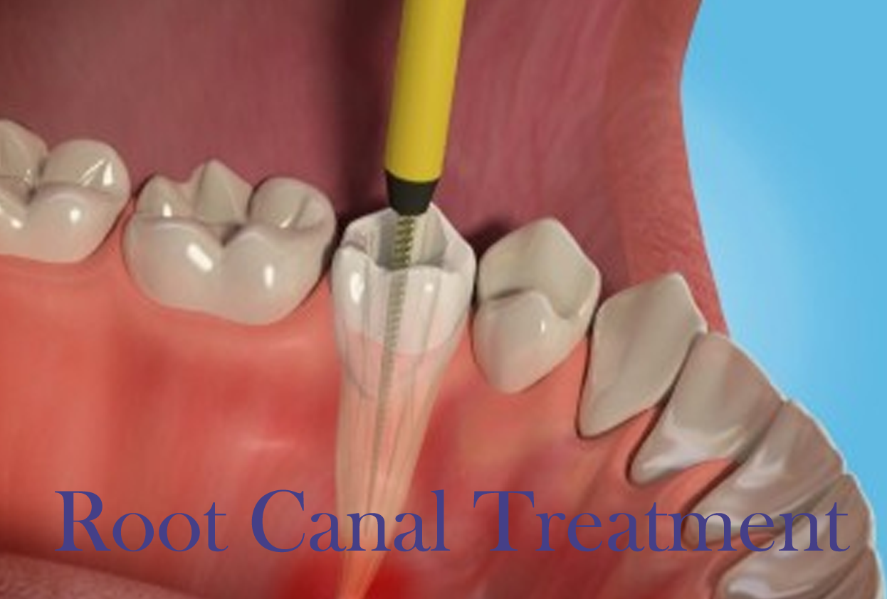 Microscopic Root Canal Treatment