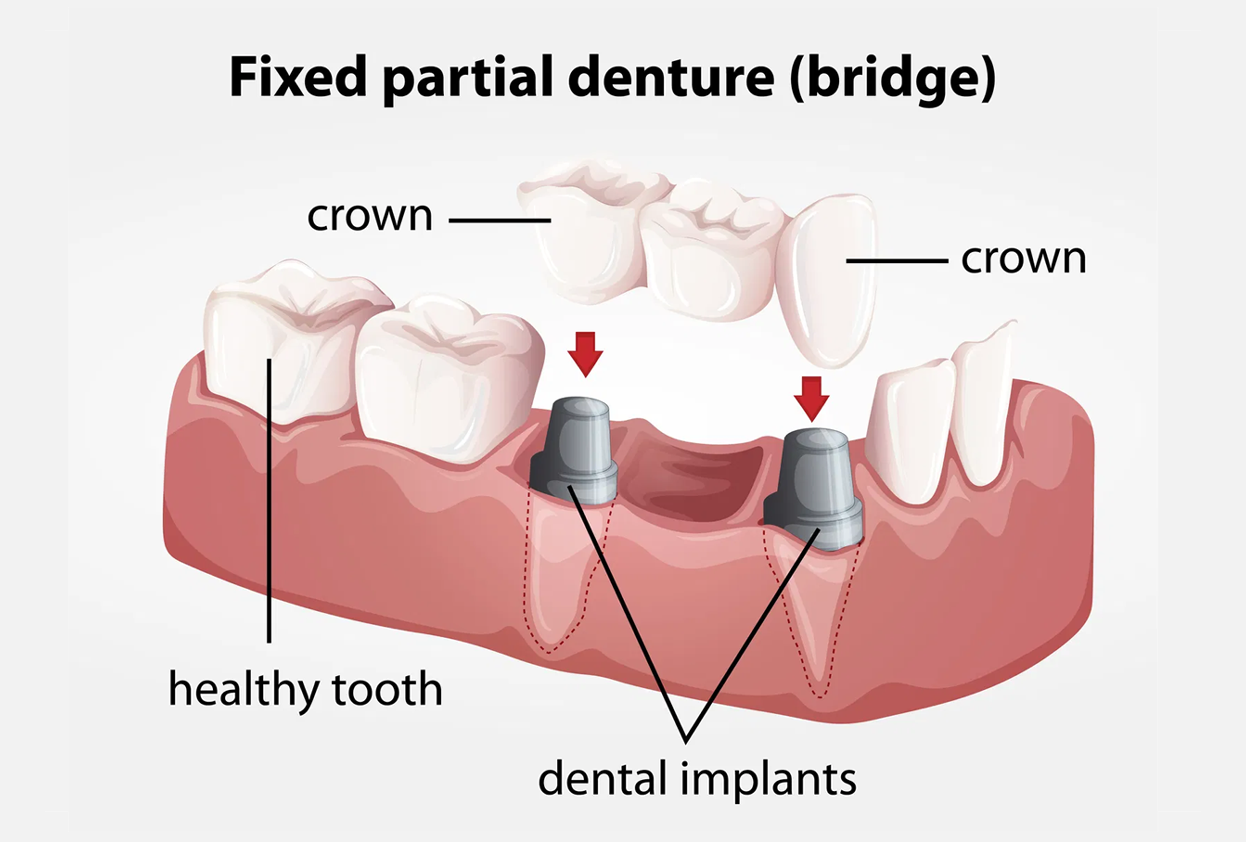 Fixed Partial Dentures